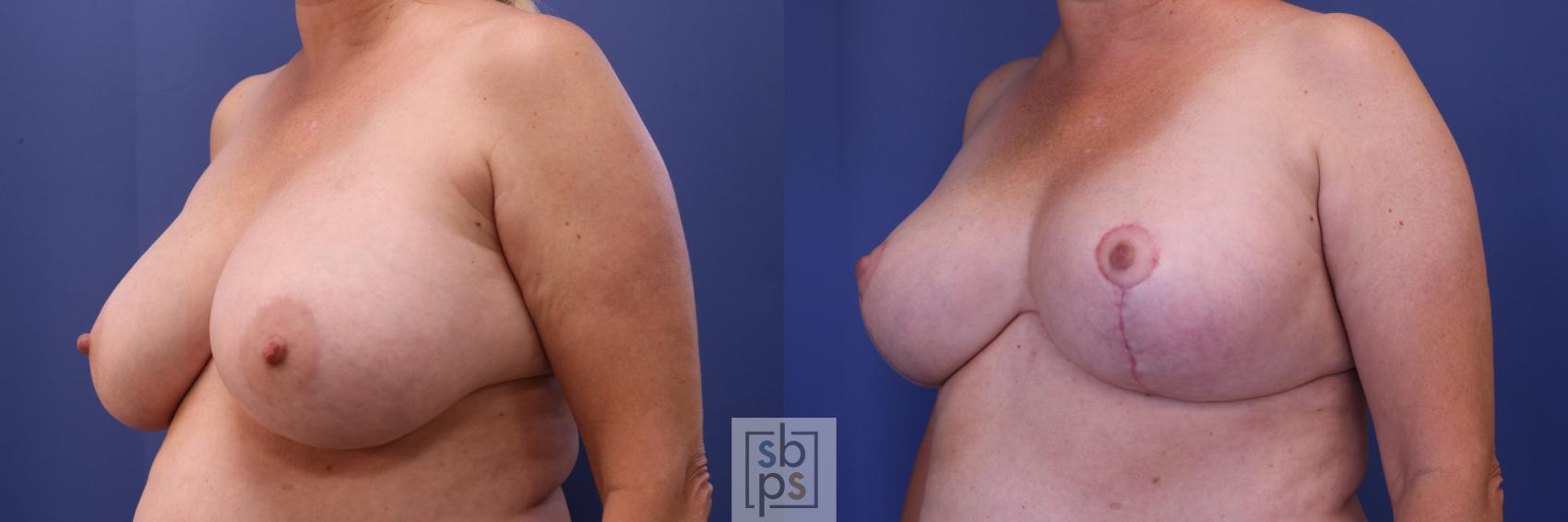 Before & After Breast Reconstruction Case 304 View #3 View in Torrance & Los Angeles, CA, CA