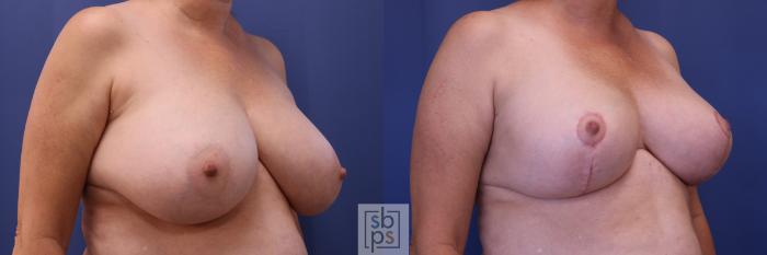 Before & After Breast Reduction Case 304 View #4 View in Torrance, CA
