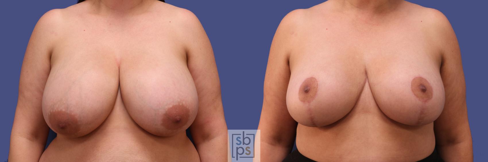 Before & After Breast Reduction Case 306 View #1 View in Torrance, CA