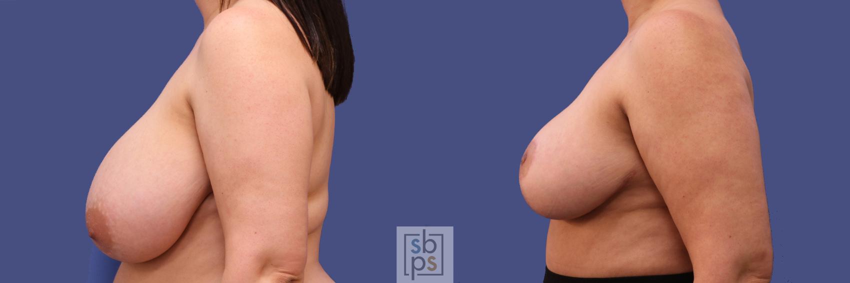 Before & After Breast Reduction Case 306 View #2 View in Torrance & Los Angeles, CA, CA