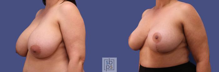 Before & After Breast Reduction Case 306 View #3 View in Torrance, CA
