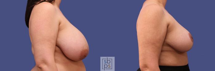Before & After Breast Reduction Case 306 View #4 View in Torrance, CA