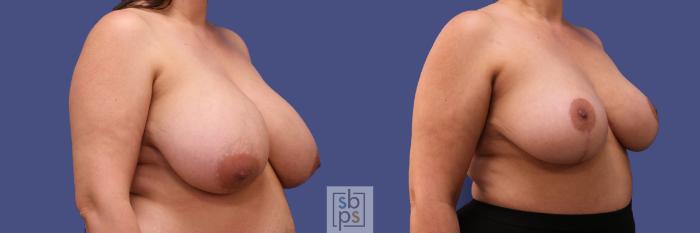 Before & After Breast Reduction Case 306 View #5 View in Torrance, CA