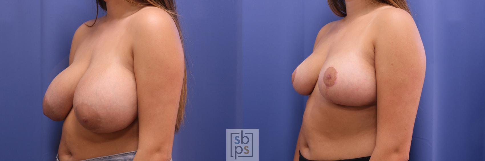 Before & After Breast Reduction Case 308 View #3 View in Torrance & Los Angeles, CA, CA