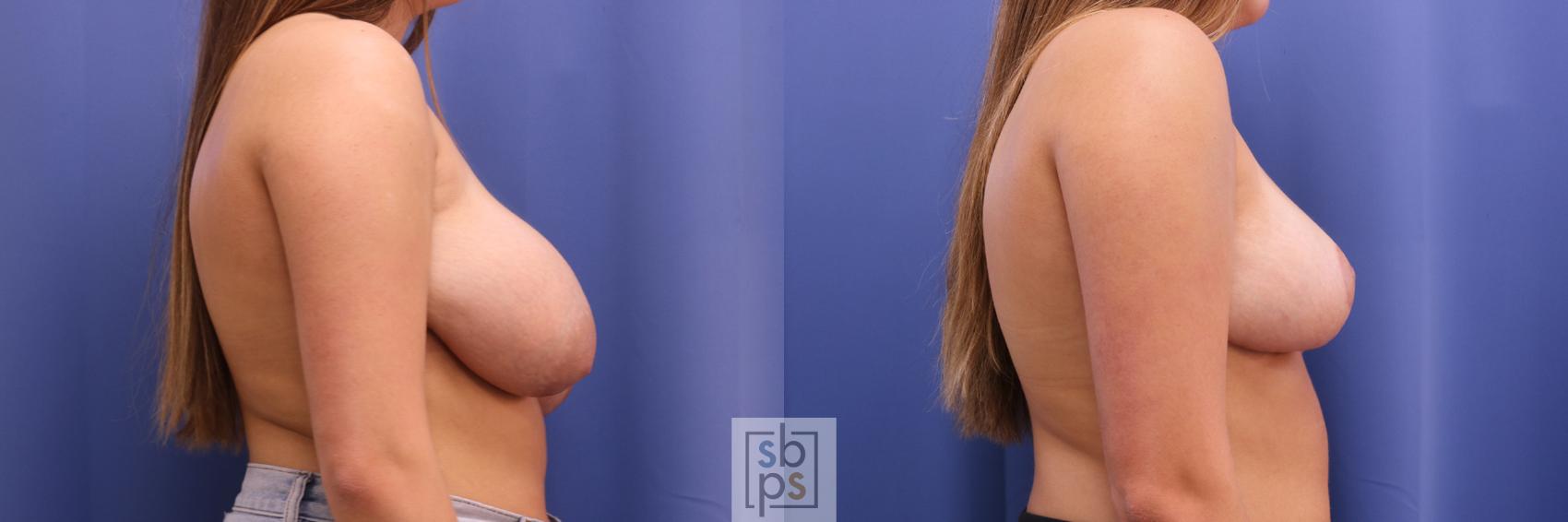 Before & After Breast Reduction Case 308 View #4 View in Torrance & Los Angeles, CA, CA