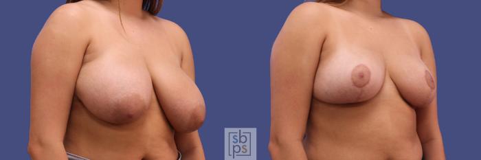 Before & After Breast Reduction Case 308 View #5 View in Torrance, CA
