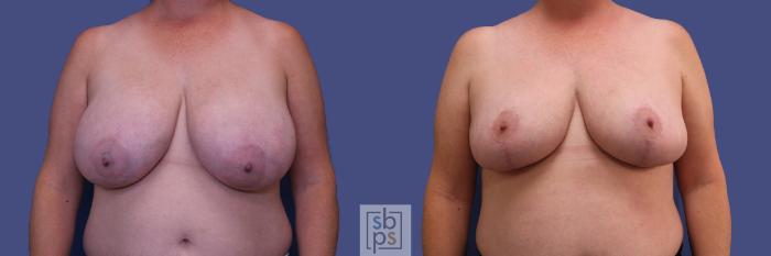 Before & After Breast Reduction Case 310 View #1 View in Torrance, CA
