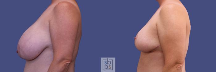 Before & After Breast Reduction Case 310 View #2 View in Torrance, CA