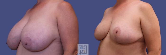 Before & After Breast Reduction Case 310 View #3 View in Torrance, CA