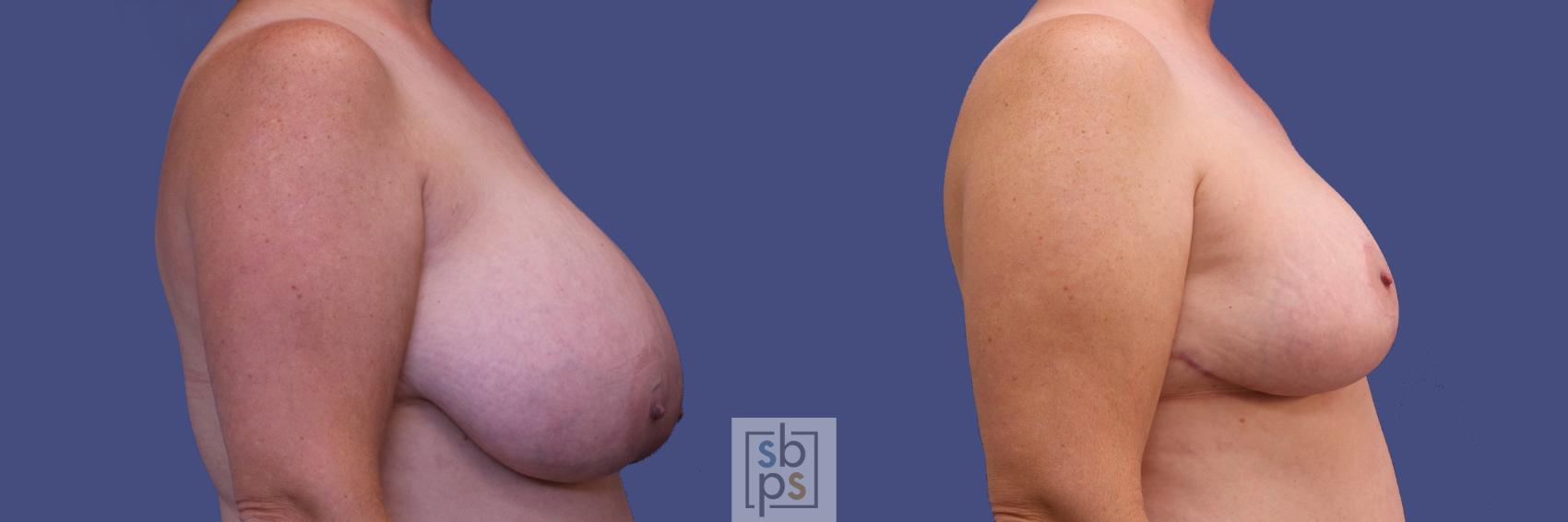 Before & After Breast Reduction Case 310 View #4 View in Los Angeles, Torrance & Long Beach, CA
