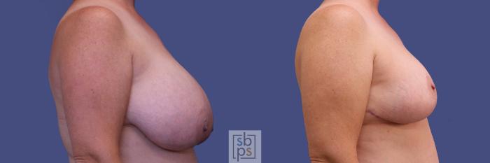 Before & After Breast Reduction Case 310 View #4 View in Torrance, CA