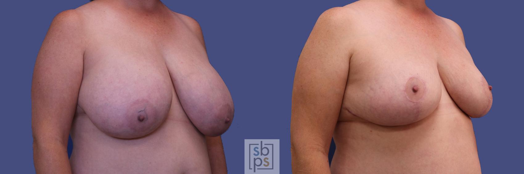 Before & After Breast Reduction Case 310 View #5 View in Los Angeles, Torrance & Long Beach, CA