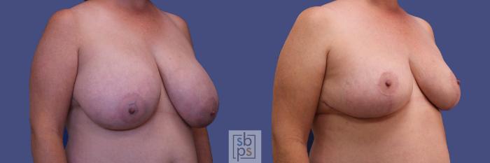 Before & After Breast Reduction Case 310 View #5 View in Torrance, CA