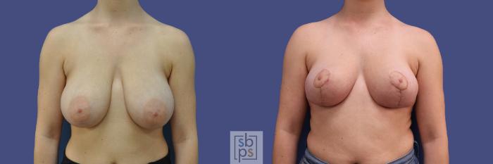 Before & After Breast Reduction Case 317 View #1 View in Torrance, CA