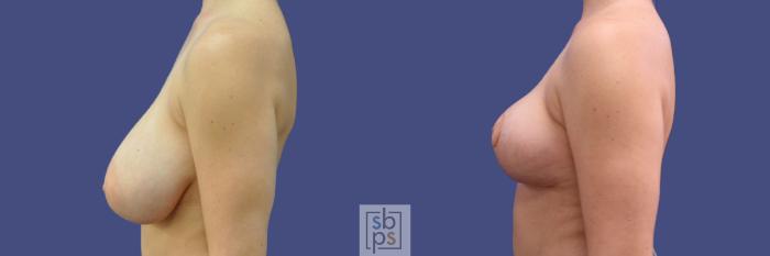 Before & After Breast Reduction Case 317 View #2 View in Torrance, CA
