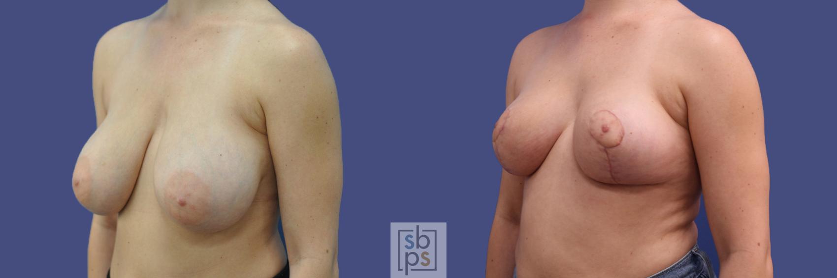 Before & After Breast Reduction Case 317 View #3 View in Torrance & Los Angeles, CA, CA