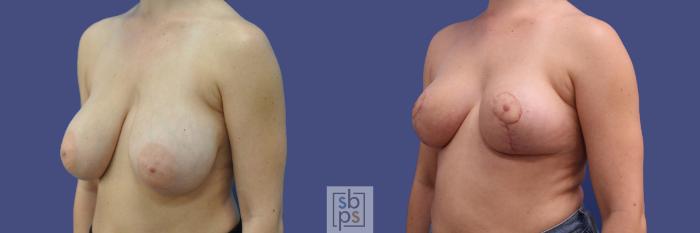 Before & After Breast Reduction Case 317 View #3 View in Torrance, CA