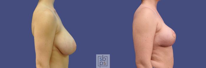 Before & After Breast Reduction Case 317 View #4 View in Torrance, CA