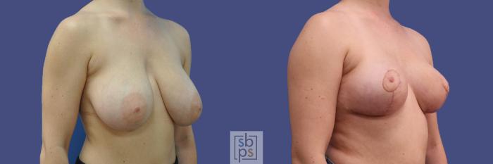 Before & After Breast Reduction Case 317 View #5 View in Torrance, CA