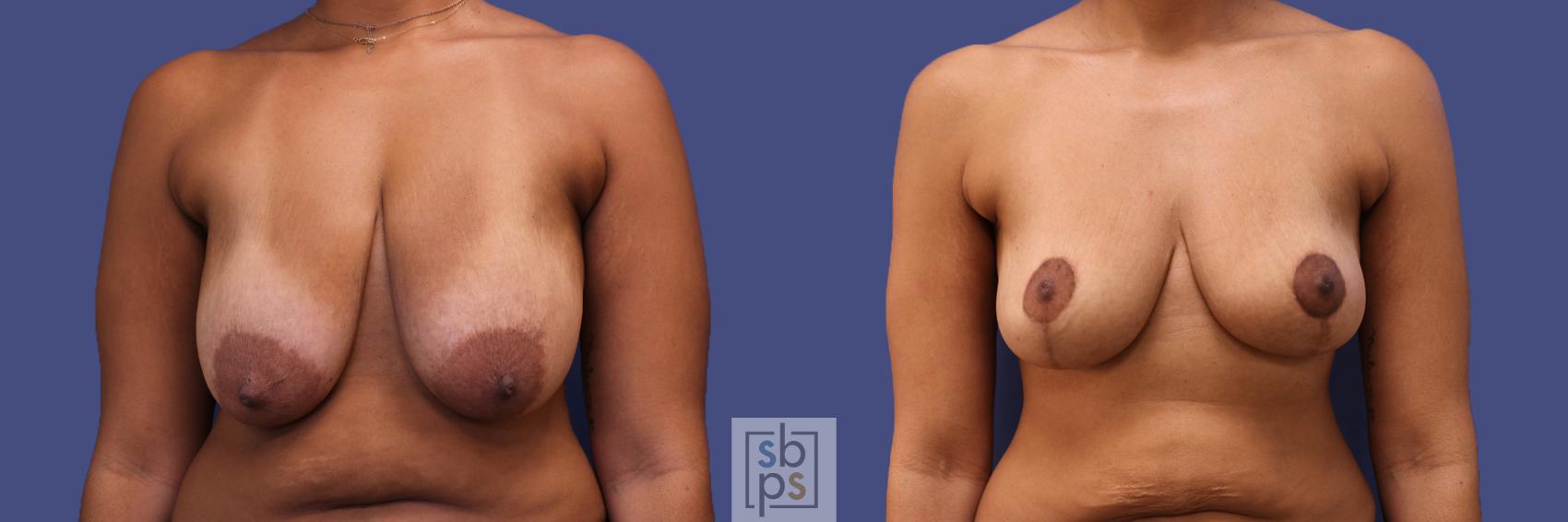 Before & After Breast Reduction Case 318 View #1 View in Torrance, CA