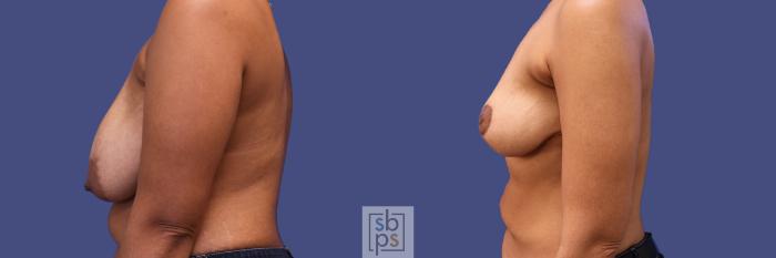 Before & After Breast Reduction Case 318 View #2 View in Torrance, CA