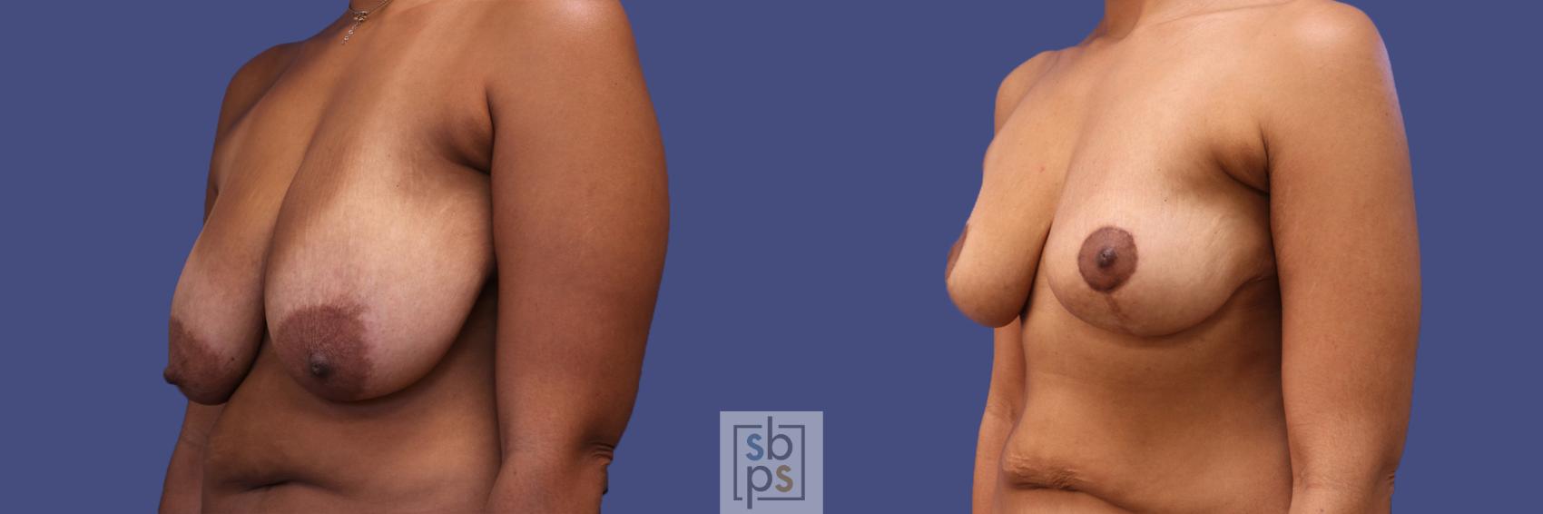 Before & After Breast Reduction Case 318 View #3 View in Torrance & Los Angeles, CA, CA