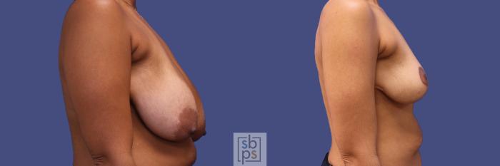 Before & After Breast Reduction Case 318 View #4 View in Torrance, CA