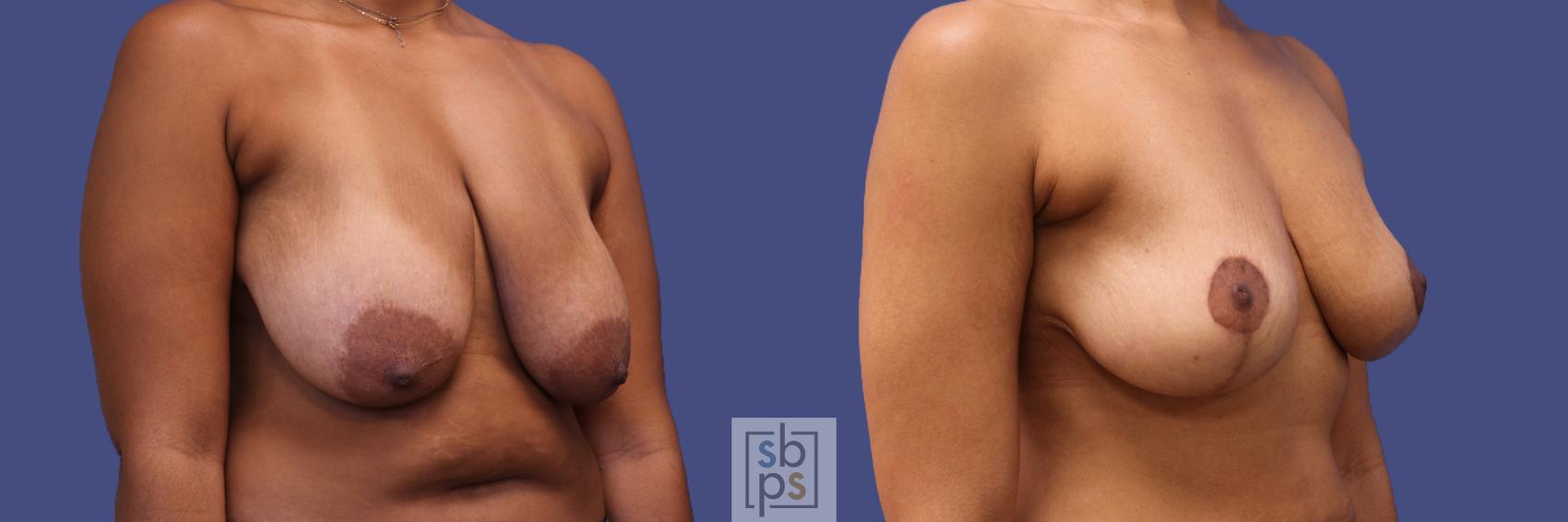 Before & After Breast Reduction Case 318 View #5 View in Torrance & Los Angeles, CA, CA
