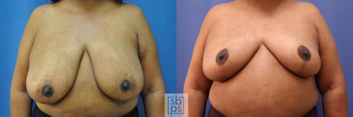 Before & After Breast Reduction Case 322 View #1 View in Torrance, CA