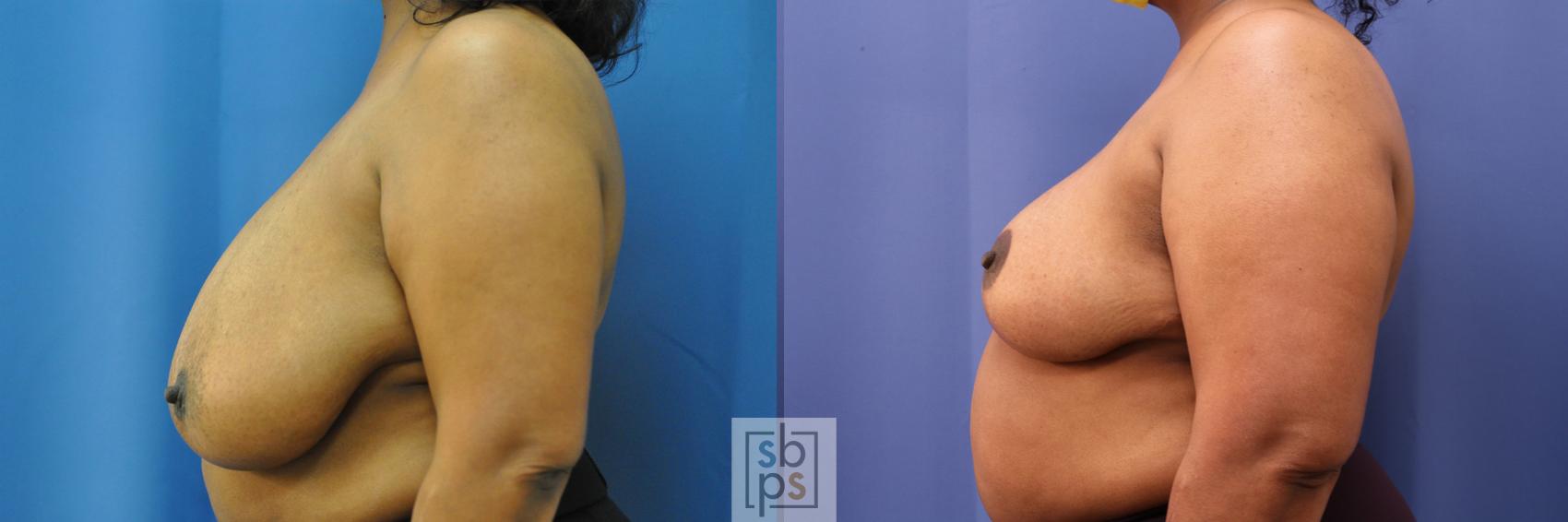 Before & After Breast Reduction Case 322 View #2 View in Los Angeles, Torrance & Long Beach, CA