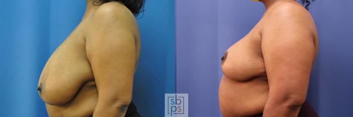 Before & After Breast Reduction Case 322 View #2 View in Torrance, CA
