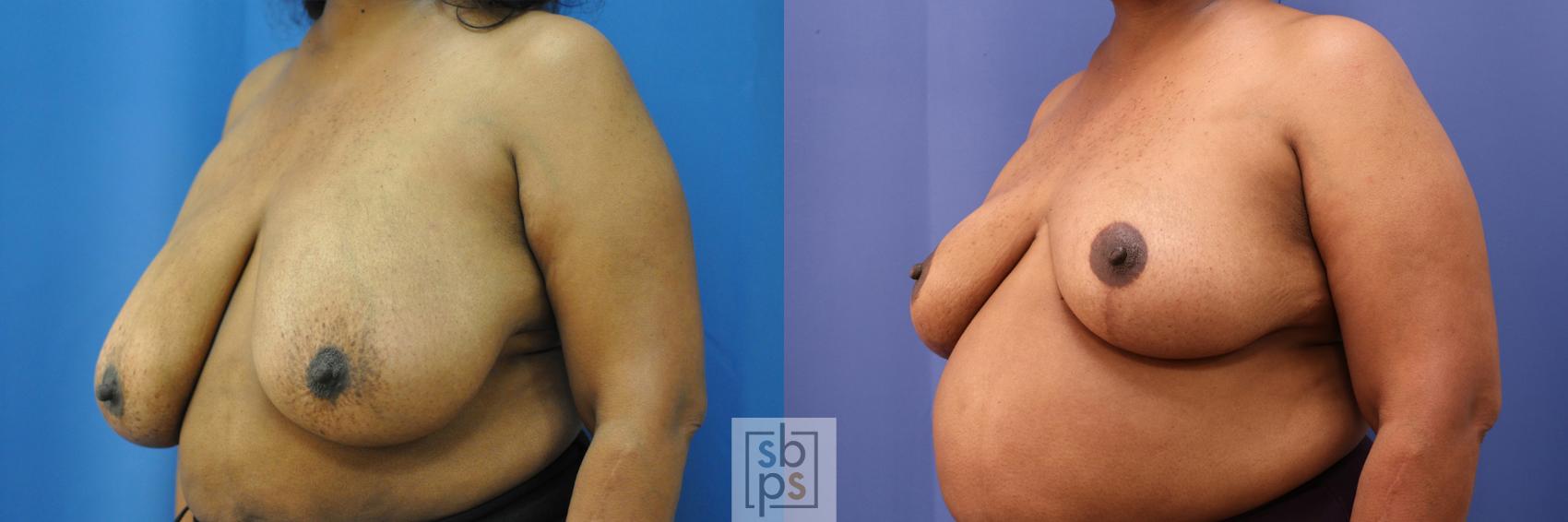 Before & After Breast Reduction Case 322 View #3 View in Los Angeles, Torrance & Long Beach, CA