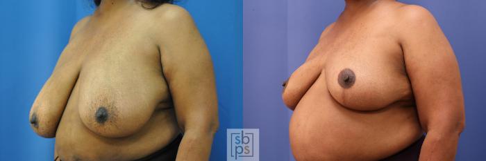 Before & After Breast Reduction Case 322 View #3 View in Torrance, CA
