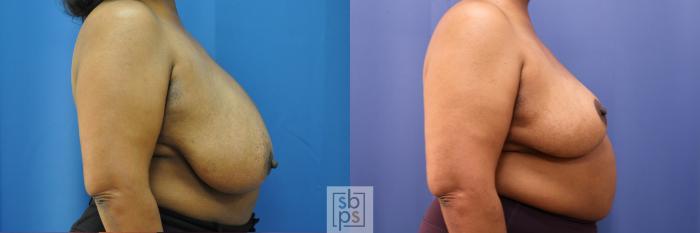 Before & After Breast Reduction Case 322 View #4 View in Torrance, CA