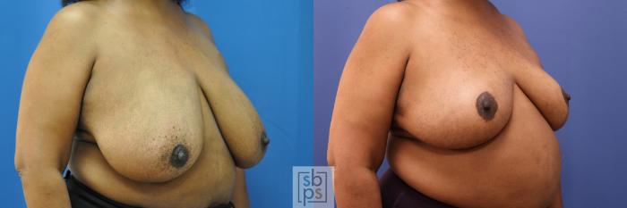 Before & After Breast Reduction Case 322 View #5 View in Torrance, CA