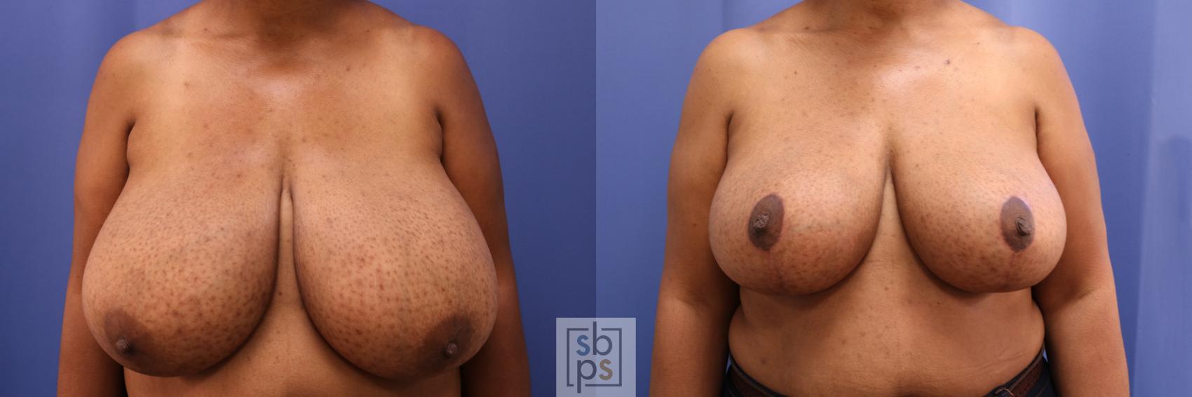Before & After Breast Reduction Case 343 View #1 View in Torrance, CA