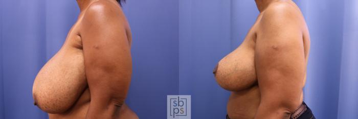Before & After Breast Reduction Case 343 View #2 View in Torrance, CA