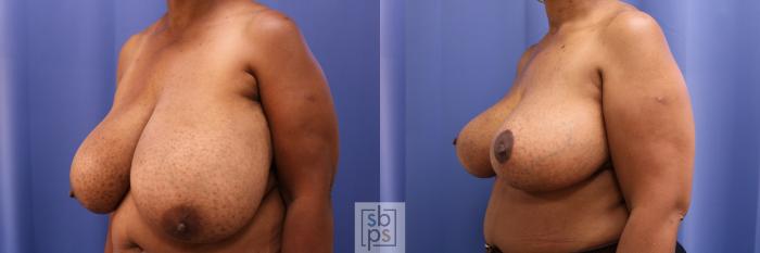 Before & After Breast Reduction Case 343 View #3 View in Torrance, CA