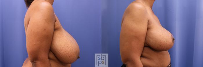 Before & After Breast Reduction Case 343 View #4 View in Torrance, CA
