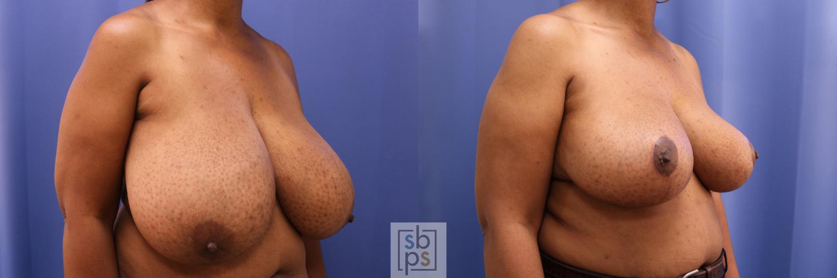 Before & After Breast Reduction Case 343 View #5 View in Torrance & Los Angeles, CA, CA