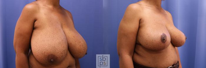 Before & After Breast Reduction Case 343 View #5 View in Torrance, CA