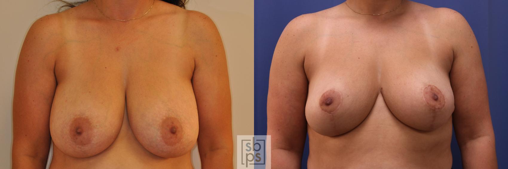 Before & After Breast Reduction Case 348 View #1 View in Torrance, CA