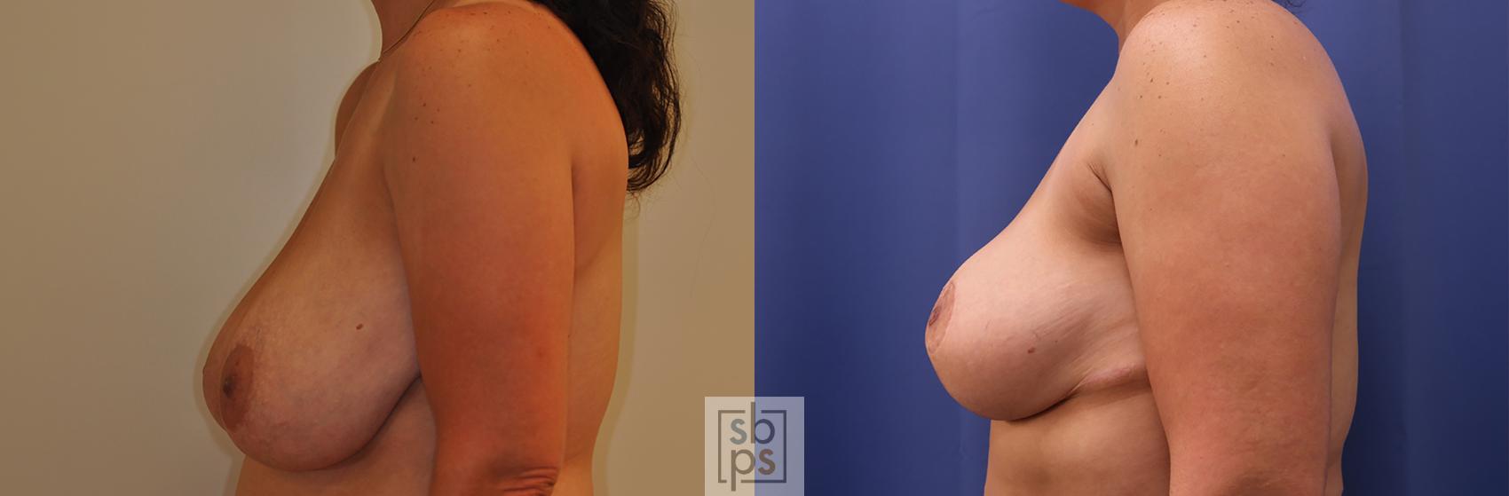 Before & After Breast Reduction Case 348 View #2 View in Los Angeles, Torrance & Long Beach, CA