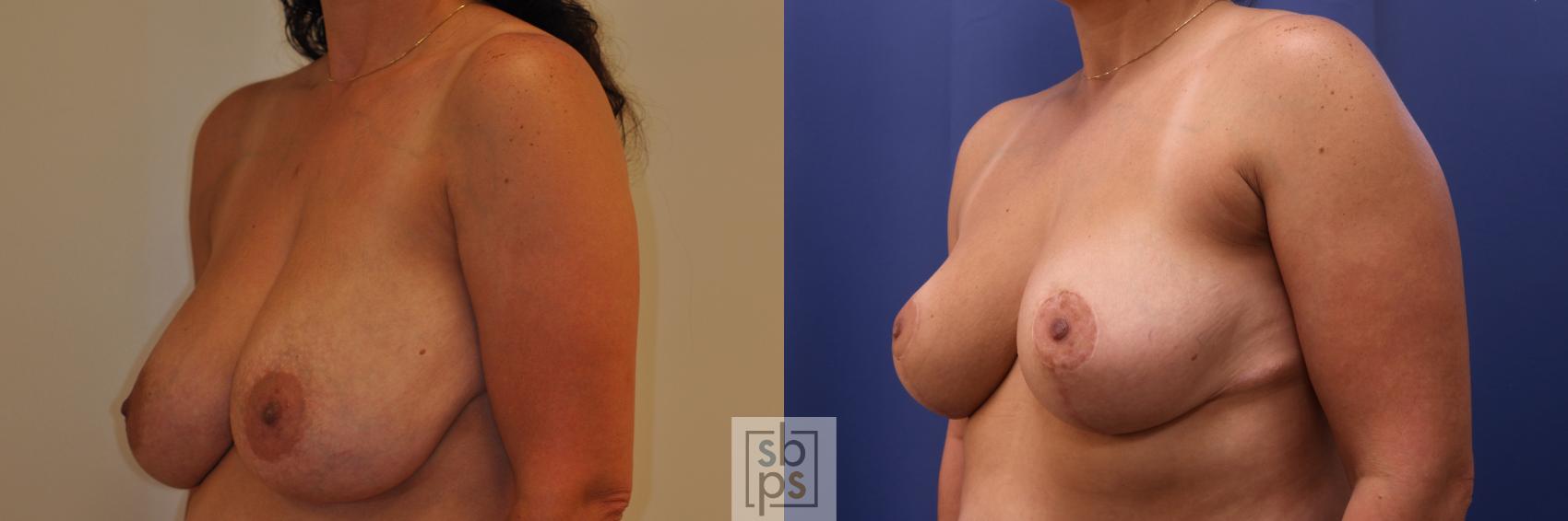 Before & After Breast Reduction Case 348 View #3 View in Los Angeles, Torrance & Long Beach, CA