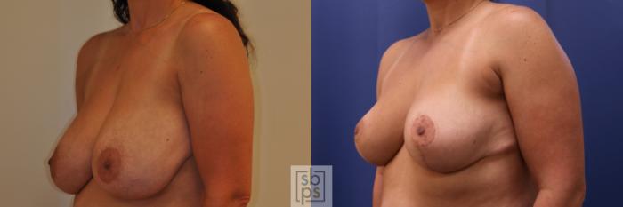 Before & After Breast Reduction Case 348 View #3 View in Torrance, CA