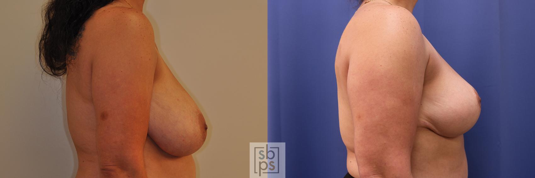 Before & After Breast Reduction Case 348 View #4 View in Los Angeles, Torrance & Long Beach, CA