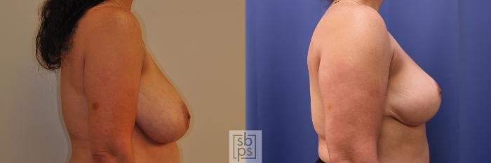 Before & After Breast Reduction Case 348 View #4 View in Torrance, CA