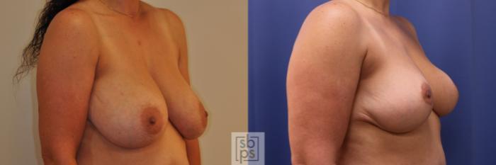 Before & After Breast Reduction Case 348 View #5 View in Torrance, CA