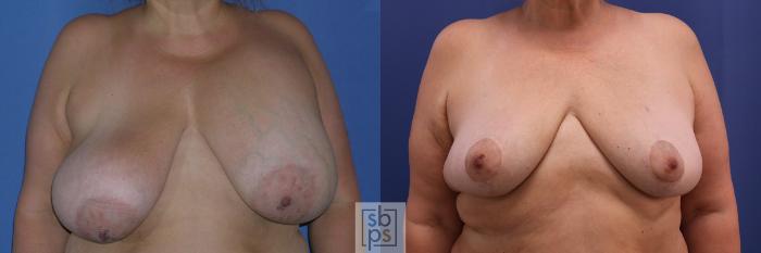 Before & After Breast Reduction Case 361 View #1 View in Torrance, CA