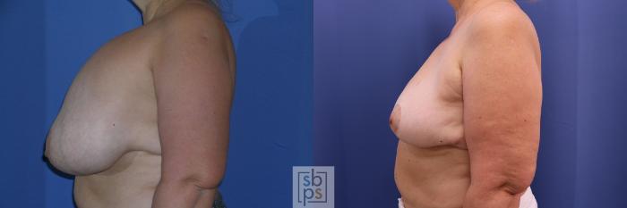 Before & After Breast Reduction Case 361 View #2 View in Torrance, CA